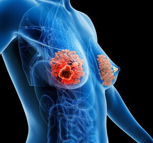 Brustkrebs im Frühstadium: Welche Patient:innen sollten auf BRCA1/2-Mutation getestet werden?