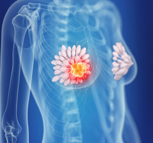 Brustkrebs: Regionale Bestrahlung vermeiden?