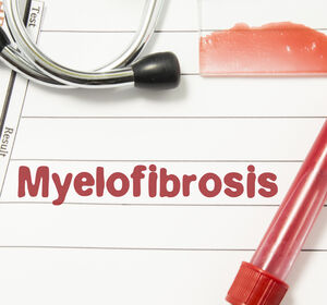 Myelofibrose: Kombination aus BET- und JAK-Inhibitoren gut verträglich und wirksam