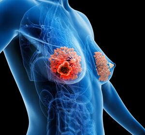 Mammakarzinom: Integrierte Bestrahlung des Tumorbetts ohne Nachteil gegenüber sequenziellem Boost