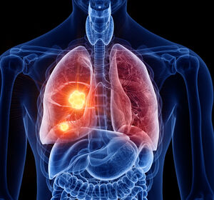 Immuntherapie eröffnet völlig neue Chancen beim frühen Lungenkarzinom