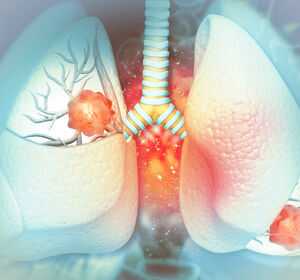 Neue Living Guideline zur Lungenkarzinom-Behandlung veröffentlicht
