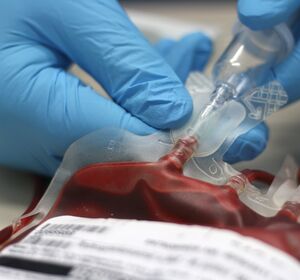 Sicherheit der intraoperativen Blutkonservierung in der Krebschirurgie - erste Ergebnisse der REMOVE-Studie