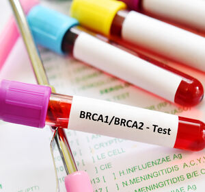 BRCA1/2-Keimbahnmutation beim Mammakarzinom: Testung ist therapierelevant!