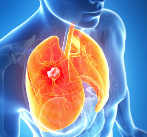Crizotinib erhält Zulassung für die Therapie des fortgeschrittenen ROS1-positiven nichtkleinzelligen Lungenkarzinoms (NSCLC) in der Europäischen Union 