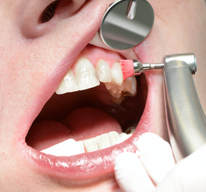 Bedeutung der Mundhygiene bei Kopf-Hals-Tumoren