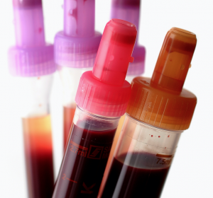 Liquid Biopsy: Krebsspuren im Blut spiegeln Therapieerfolg
