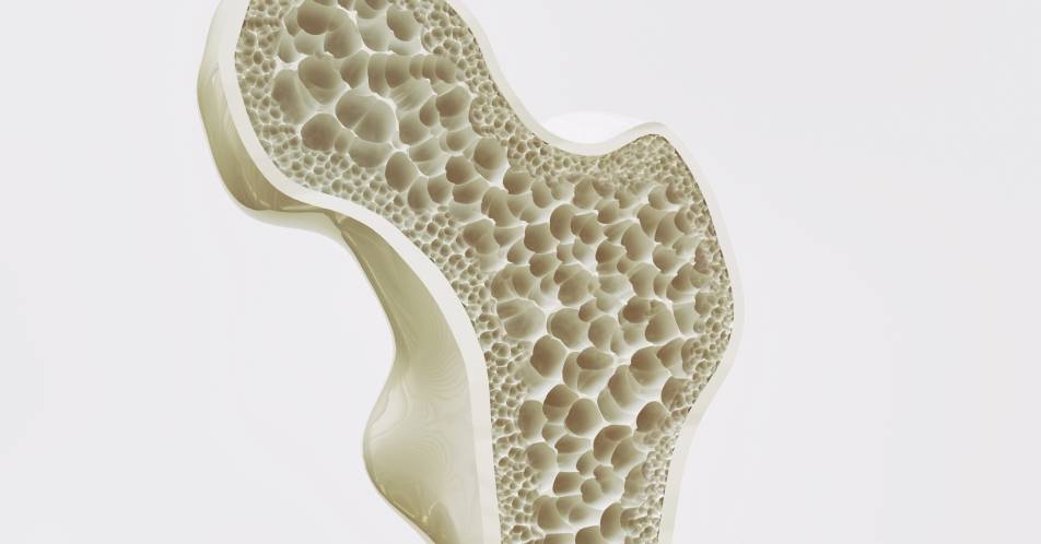 Schutz vor Osteoporose bei hormoneller Krebstherapie