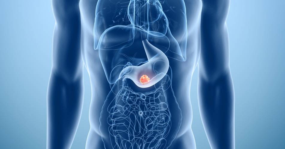 Tumoren im Magen-Darm-Trakt: Operationserfolg in spezialisierten Kliniken deutlich größer 