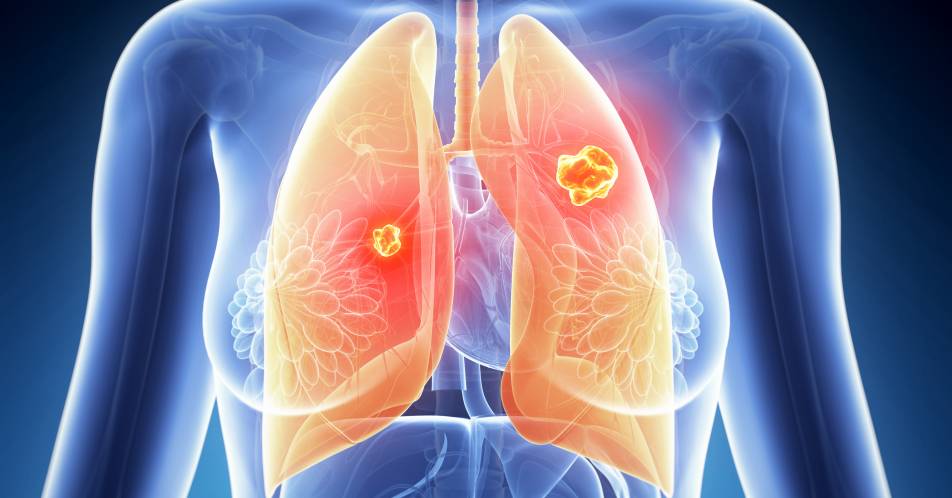 Studiendaten bestätigen Fortschritte mit Atezolizumab und Alectinib beim fortgeschrittenen Lungenkarzinom
