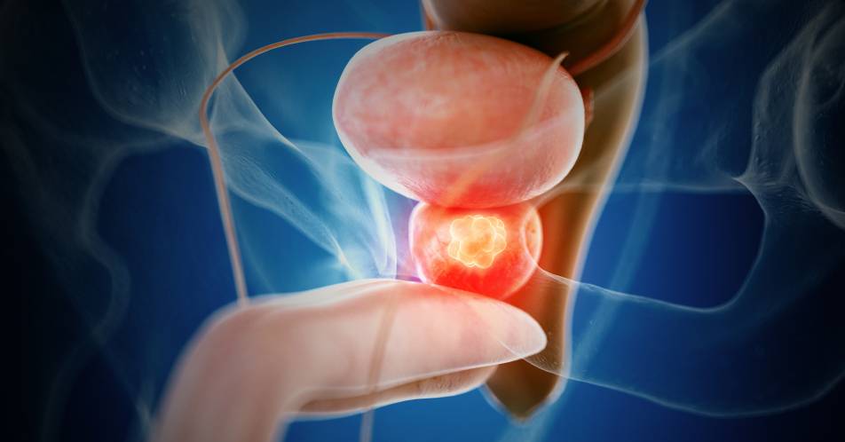 Metastasiertes Prostatakarzinom: Die Chancen der Chemotherapie rechtzeitig nutzen