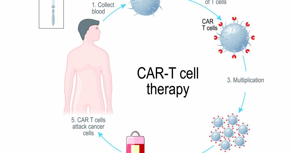 Patientenselektion für die CAR-T-Zell-Therapie
