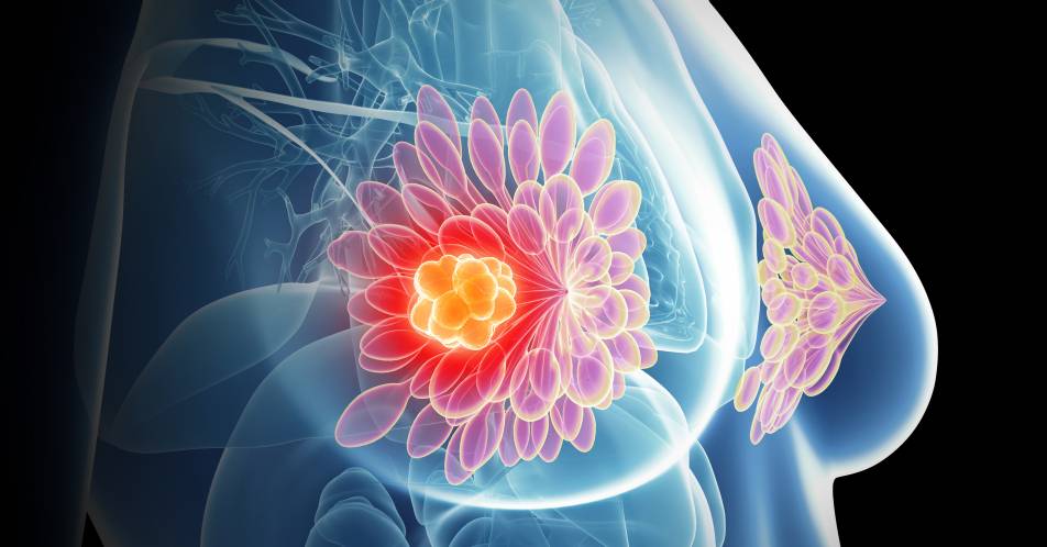 Mammakarzinom: Tumorgewebe erlaubt Krankheitsprognostik