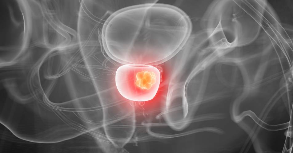 Prostatakarzinom: Anstieg der PSMA-Dichte auf Tumorzellen durch Enzalutamid-Gabe über Medikamentenwirkung hinaus