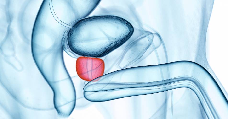 Prostatakarzinom: Positionspapier der DGU zum Screening mittels PSA-Test