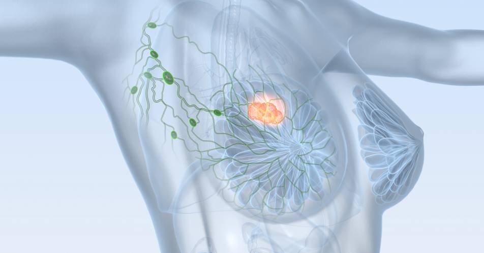 ExteNET-Studie: Ausweitung der adjuvanten Therapie mit Neratinib bei HR+/HER2+ Brustkrebs senkt Rezidivrisiko
