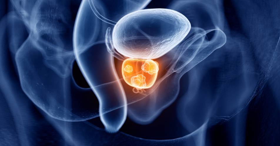 Prostatakarzinom: DGU kritisiert IQWiG-Vorbericht zum Screening mittels PSA-Test