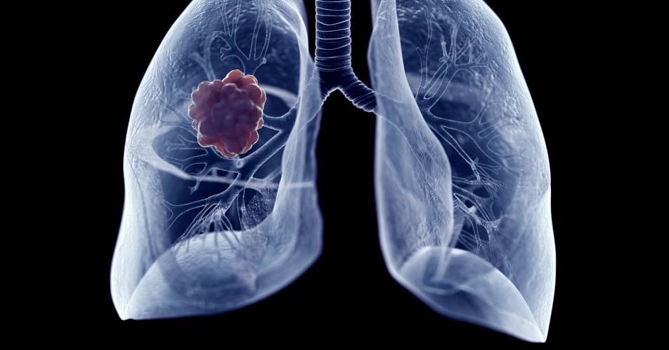 Pneumo-Onkologie: Studiendaten zu Atezolizumab und Alectinib beim fortgeschrittenen Lungenkarzinom