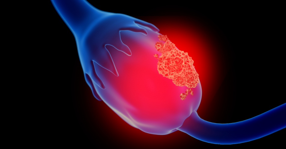 Platinsensitives Ovarialkarzinom: Olaparib-Erhaltungstherapie unabhängig vom BRCA-Mutationsstatus