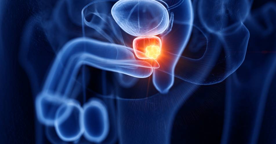Prostatakarzinom: ADT als Therapiestandard