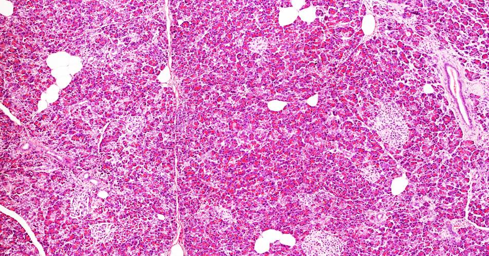 Metastasiertes Pankreaskarzinom: Keine neuen Sicherheitshinweise in Phase-III-Studie zu Eryaspase