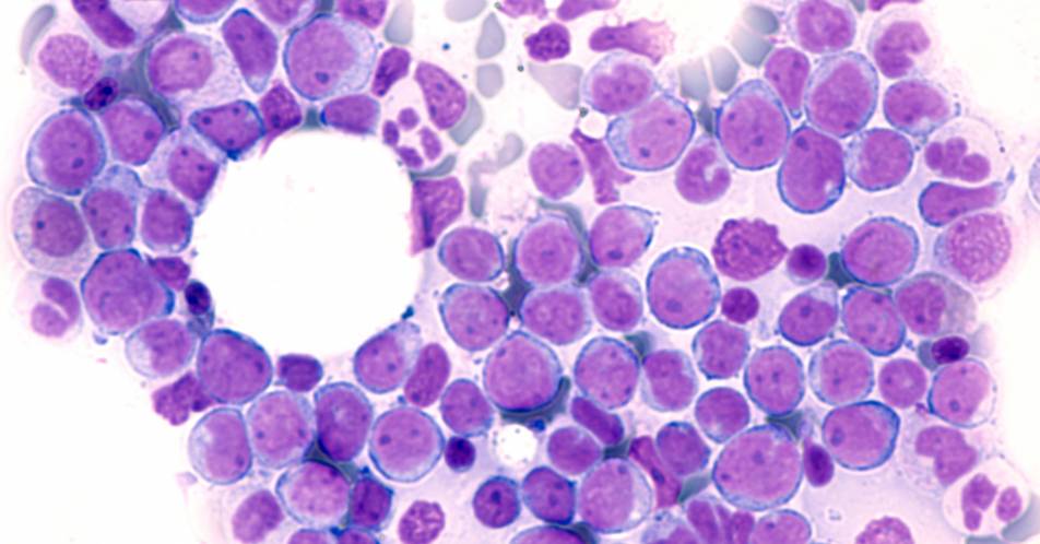 AML: Selektive Eliminierung von Krebs- und Blutstammzellen