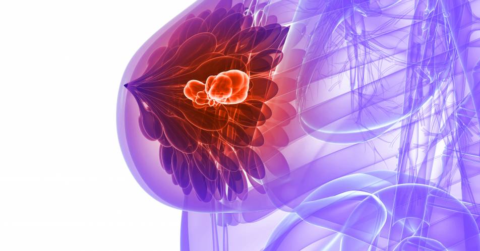 Patienten-Reported Outcome: Ribociclib + Fulvestrant als Erst- und Zweitlinientherapie bei fortgeschrittenem Brustkrebs