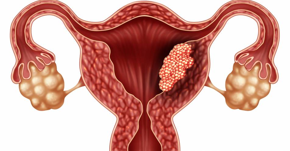Fortgeschrittenes Endometriumkarzinom: Vielversprechende Ergebnisse einer frühen Therapie mit Lenvatinib + Pembrolizumab
