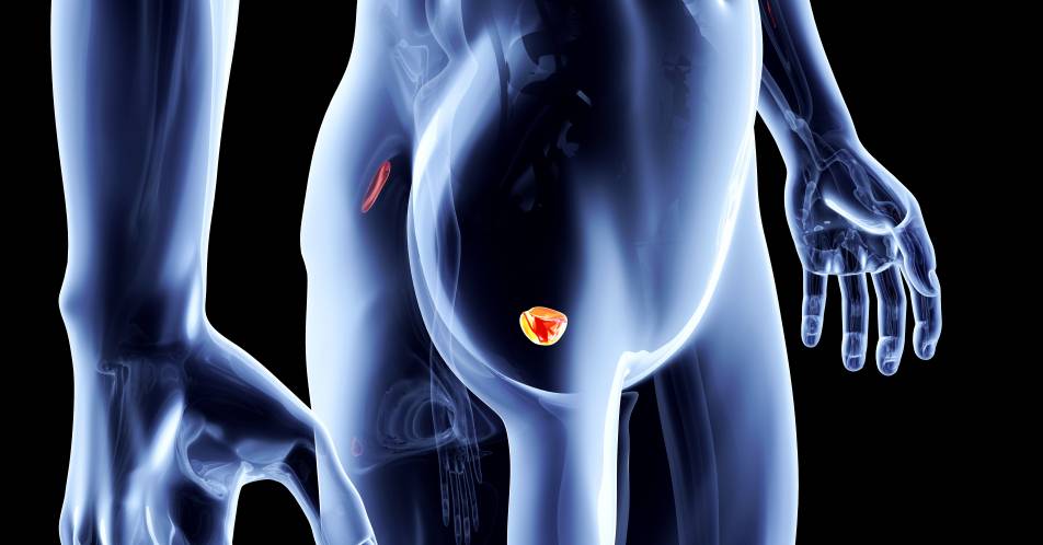 Prostatakarzinom: Kein Anhaltspunkt für höheren Nutzen oder Schaden bei Anwendung der Fusionsbiopsie