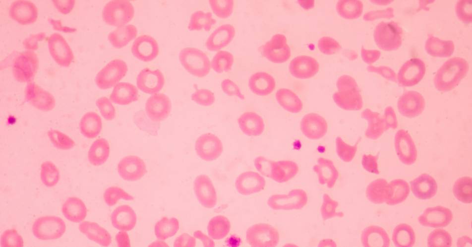 Beta-Thalassämie: Zulassung für Luspatercept zur Behandlung von Patienten mit transfusionsabhängiger Anämie