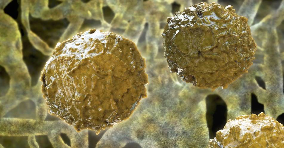 Adenovirus-Infektion nach Stammzelltransplantation: Arsentrioxid stärkt körpereigene Abwehr