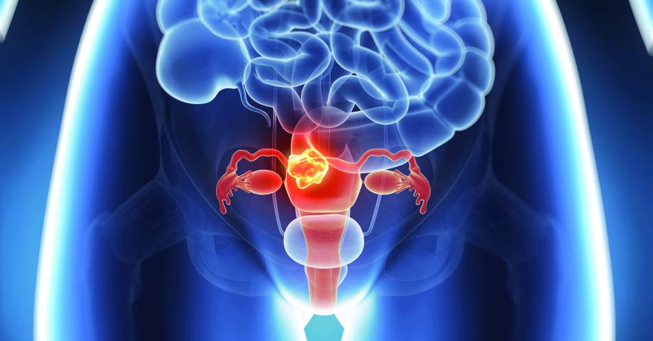 Prostata- und Ovarialkarzinom: Klinisch bedeutsamer OS-Vorteil unter Olaparib