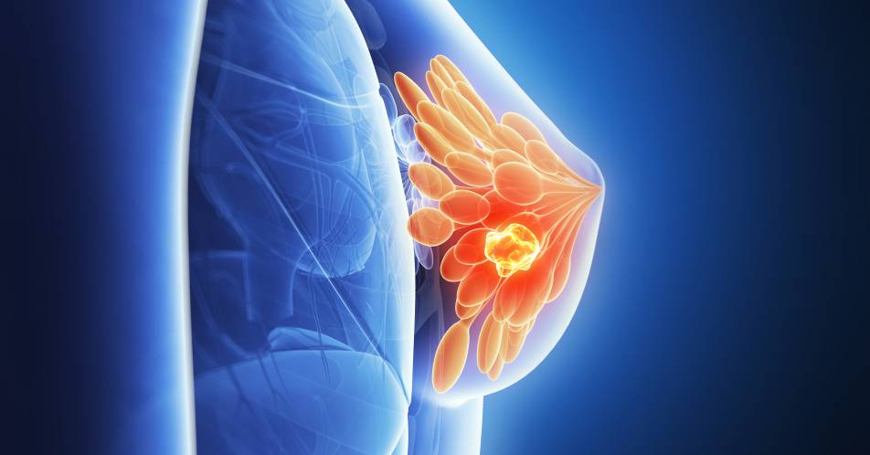 Neue ESO-ESMO-Leitlinie (ABC 5) zu Brustkrebs veröffentlicht: Experten-Panel sieht CDK4/6-Inhibitoren für Mehrzahl der PatientInnen in der Erstlinie