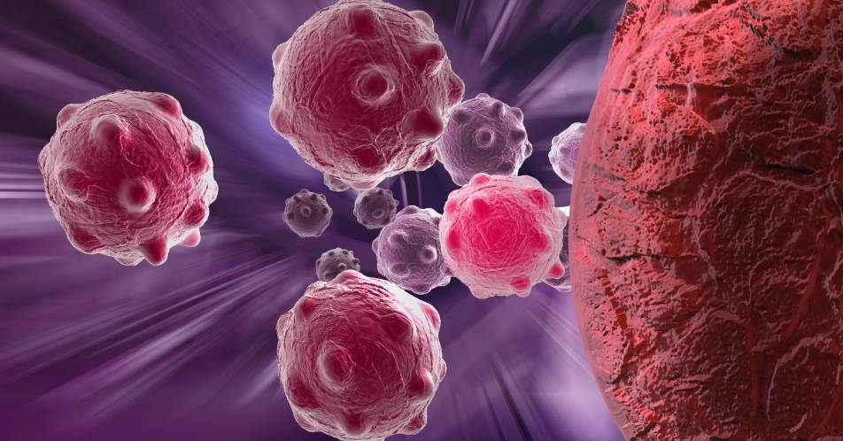 r/r AML: Überlebensvorteil unter Gilteritinib-Therapie nach allogener Stammzelltransplantation