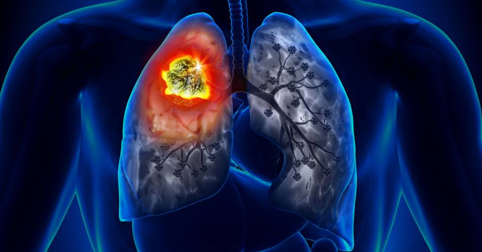 Immuntherapie bei SCLC und NSCLC: Mehr Lebenszeit bei Lungenkrebs