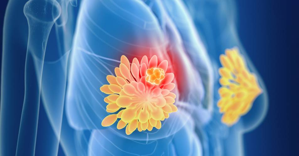mikroRNA hemmt das Wachstum: Regulatorisches Biomolekül könnte Ansatz gegen Brustkrebs sein