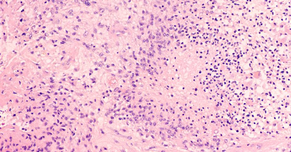 TAMEP-Zellen als Tumortreiber: Möglicher Ansatz gegen Glioblastome