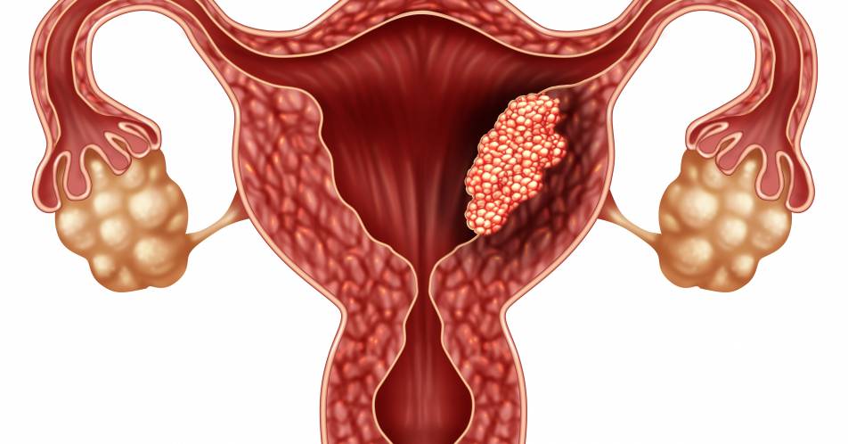 Pembrolizumab + Lenvatinib beim Endometriumkarzinom