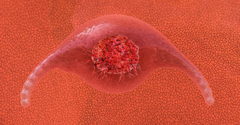 Cemiplimab mono bei fortgeschrittenem Zervixkarzinom: Phase-III-Studie wegen positiver Ergebnisse vorzeitig beendet