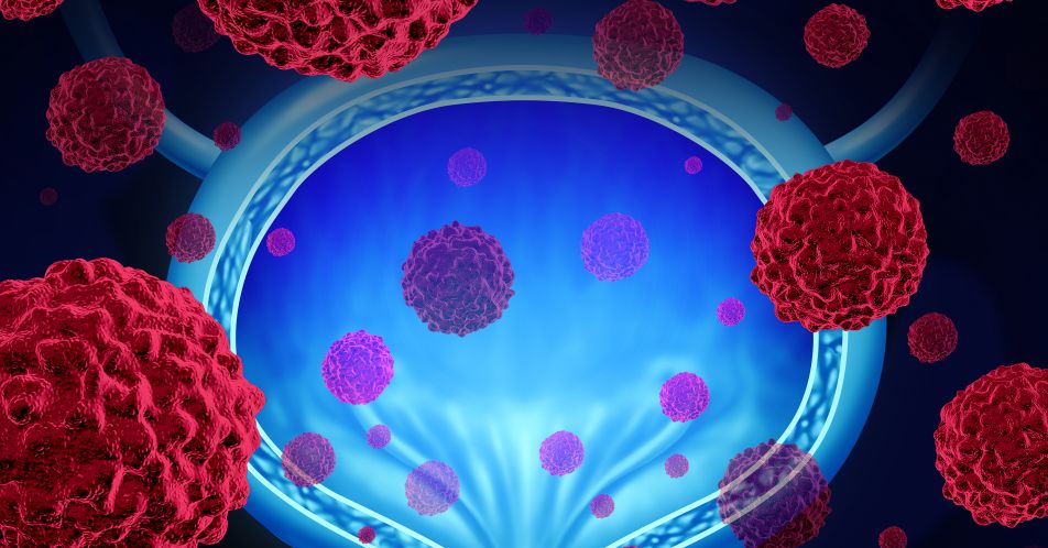 Nicht-muskelinvasives Blasenkarzinom: Phase-I-Studie zu trifunktionalem Antikörper Catumaxomab gestartet
