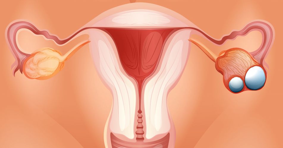 Endometriumkarzinom: Bedingte Zulassung für Dostarlimab