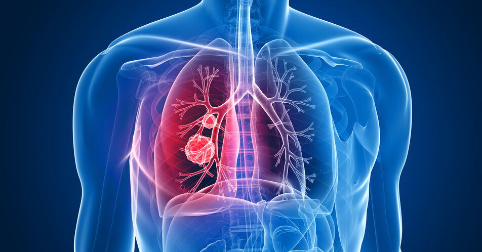 Marker für Erfolg bei Lungenkrebs-Immuntherapie identifiziert