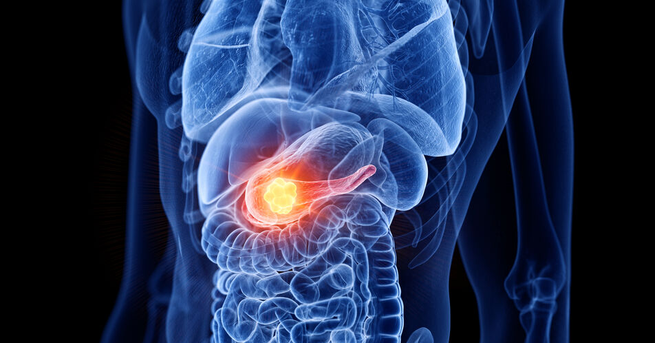Pankreaskarzinom: Neue Behandlungsoption in der Geriatrie
