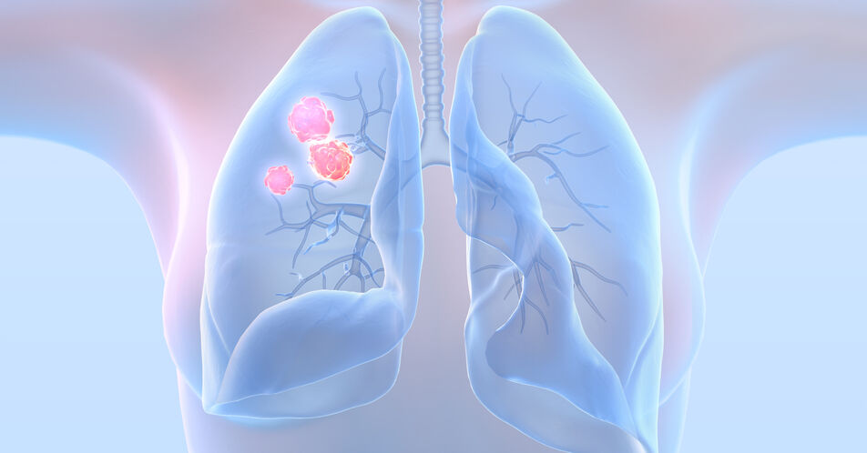 Lungenkarzinom: Endlich eine Perspektive beim fortgeschrittenen Kleinzeller