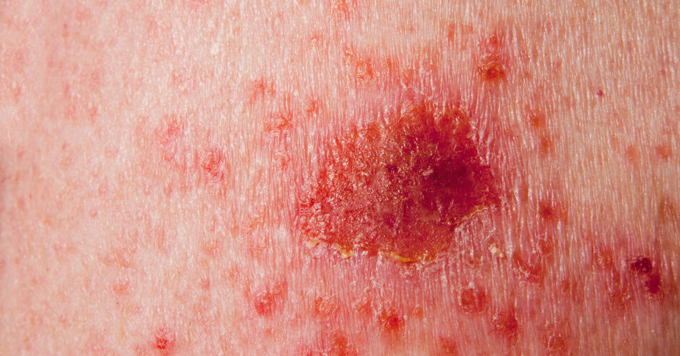 Hautkrebspatienten profitieren von neuen dermato-onkologischen Strategien