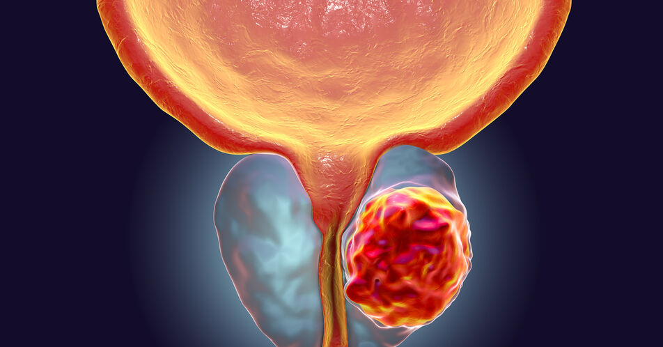 Metastasiertes Prostatakarzinom: Radioligandtherapie verlängert Überlebenszeit