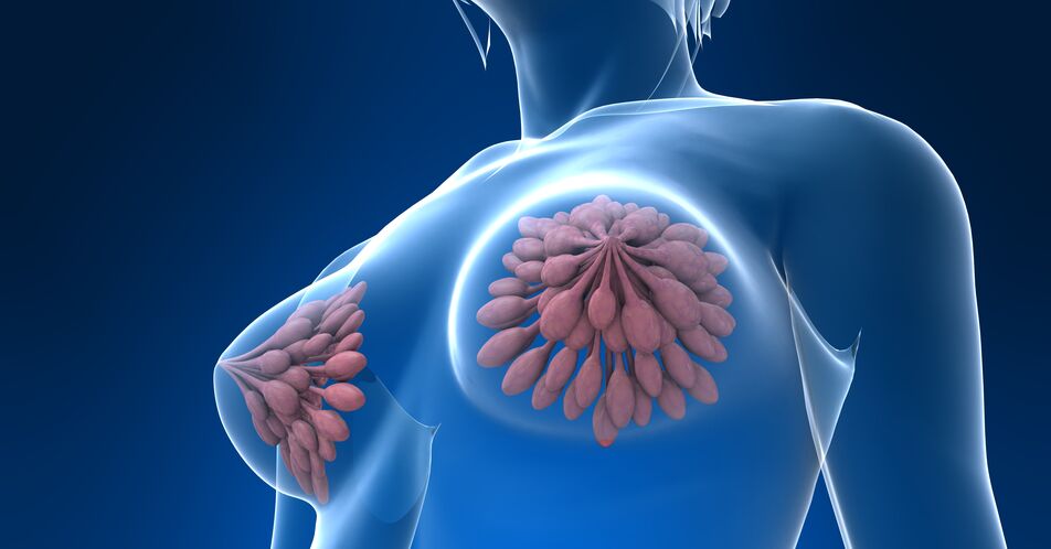 Nodal-positiver Brustkrebs: Chemotherapie durch Test vermeidbar