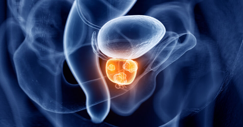 Prostatakarzinom: Ist eine nicht-invasive Diagnostik möglich?