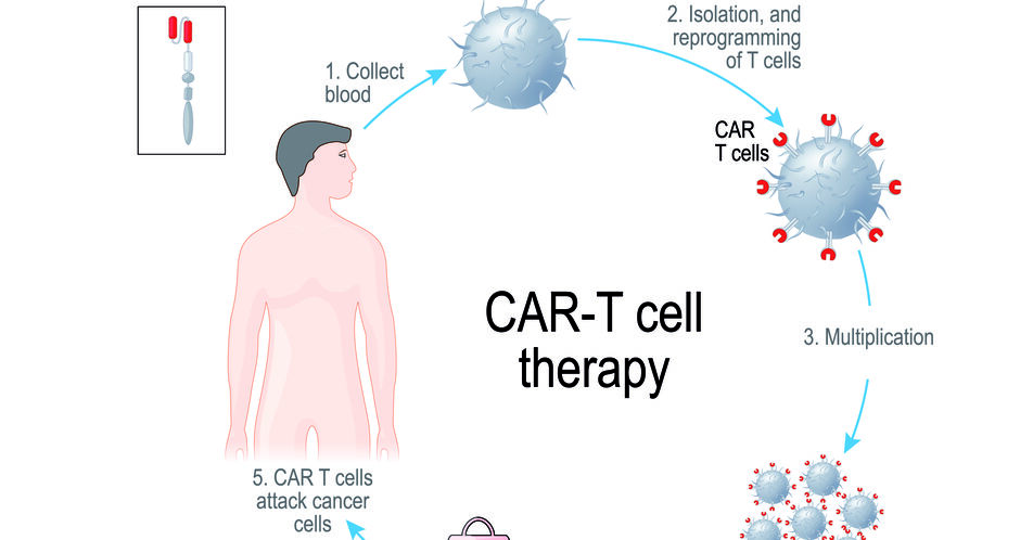 CAR-T-Zell-Therapie neu beim LBCL