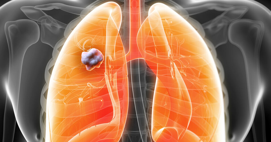 Online-Informationsportal zu Lungenkarzinomen für Fachärzt:innen